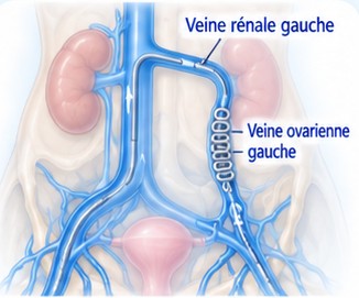 Illustration : Varices pelviennes